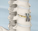 Anterior Cervical Discectomy with Fusion