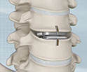 Artificial Cervical Disc Replacement