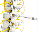 Epidural Steroid Injection