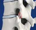 Lumbar Facetectomy Surgery