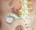Spinal Cord Stimulator Implant Surgery